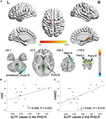 Disrupted Spontaneous Neural Activity and Its Interaction With Pain and Emotion in Temporomandibular Disorders